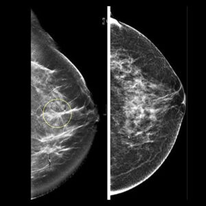Mammography test in South Delhi